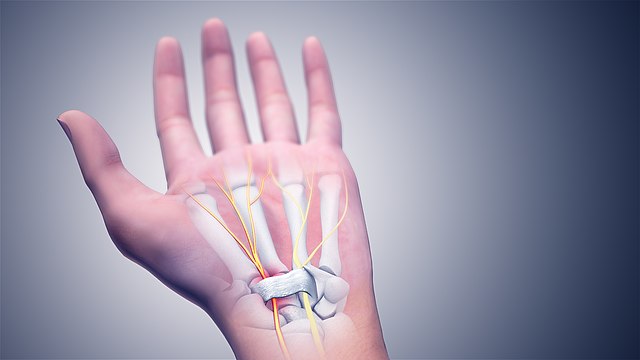 Carpal Tunnel Syndromes (Source: Wikimedia.org)