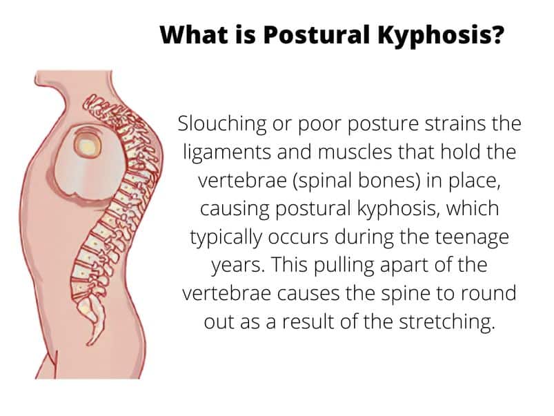 Postural Kyphosis